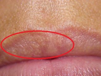Fordyce spots