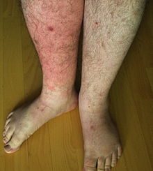 what is erysipelas