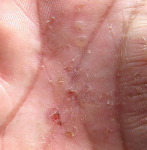 Dyshidrotic Eczema Dyshidrosis Symptoms Causes Treatment And