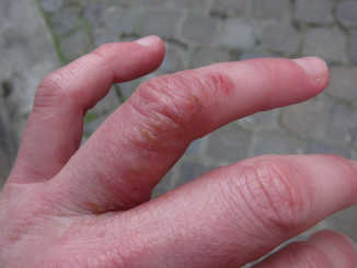 Dyshidrotic Eczema: Overview, Causes, Diagnosis & Pictures