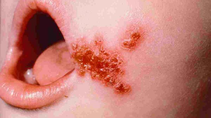 Infantigo Infantigo - Pictures, Contagious, Causes, Symptoms, Treatment