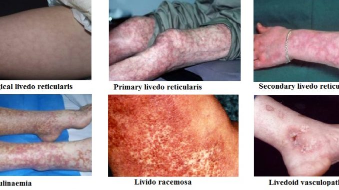 Livedo reticularis types Livedo Reticularis - Definition, Causes, Types, Diagnosis, Cure