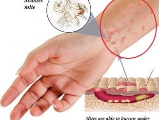 Scabies Rash Treatment, Symptoms and prevention