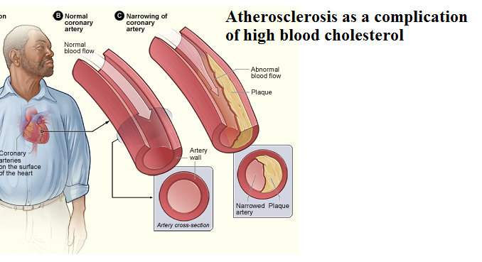 atherosclerosis as a complication What is considered a dangerous level of cholesterol? What are the risks of high cholesterol?