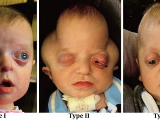 Pfeiffer Syndrome - Type 2 and 3, Symptoms, Causes, Treatments, Pictures