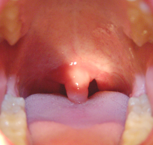 Throat And Uvula 111