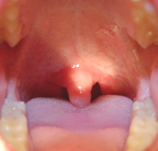 Swollen Uvula Causes Symptoms Pictures Treatment And Prevention