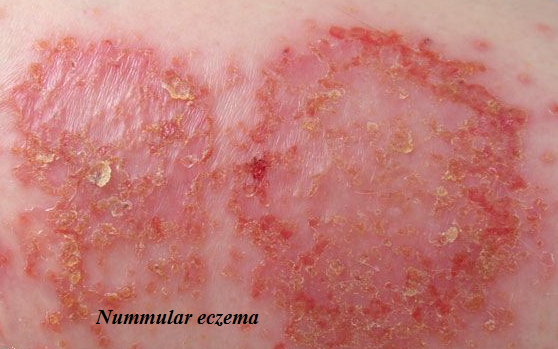 Nummular Eczema Definition Complications Causes Treatments And