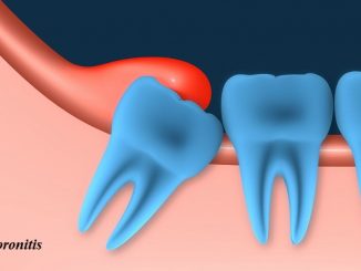 Pericoronitis - Definition, Reasons, Sign and Symptoms, Contagious, Pain management and Prevention