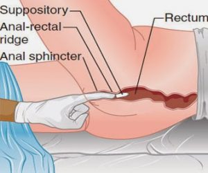 rectal suppository for constipation