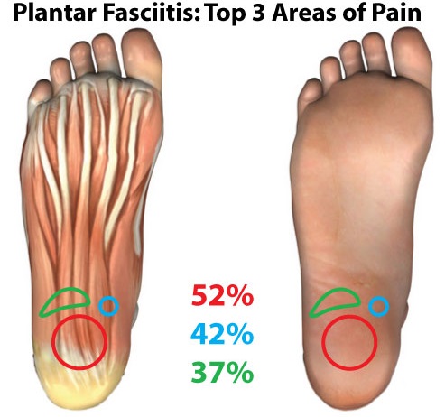 plantar fasciitis pain area