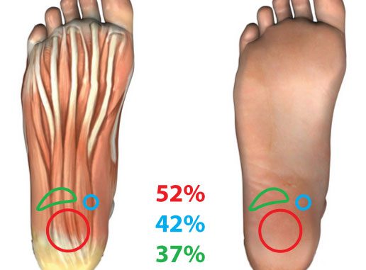 Plantar fasciitis the most frequent areas of pain Where does your foot hurt with plantar fasciitis?