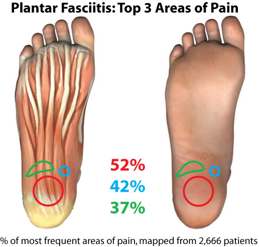 Where does your foot hurt with plantar fasciitis?