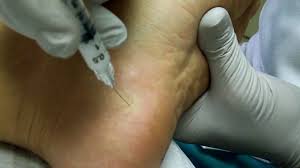 is dry needling effective for plantar fasciitis