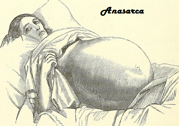 Anasarca - Definition, Pathophysiology, Pictures, Causes, Treatment