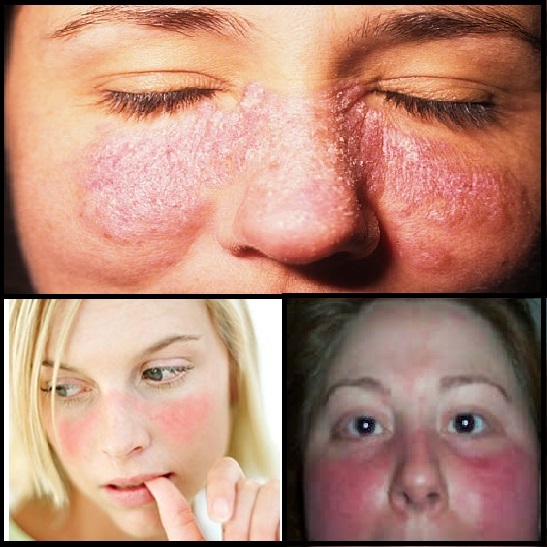 Lupus Rash Types Effects Diagnoses Treatments Prevention And