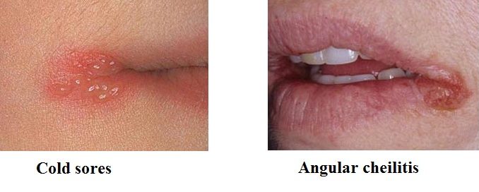 What is Angular cheilitis? Symptoms, Types, Causes, Chronic, Treatments ...