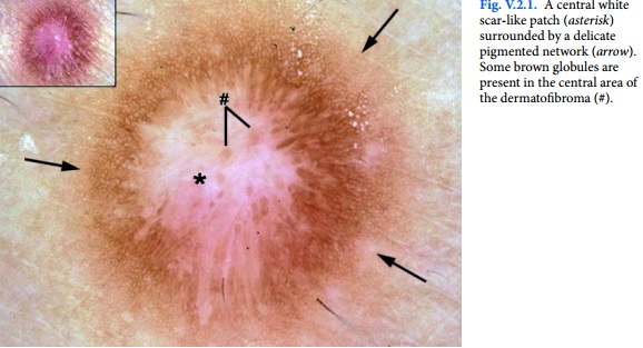 🔍 DERMATOFIBROMA -Delicate pigment network -Central scar-like white parch  -Ring-like globules @florbelocopitow #dermoscopy #dermato