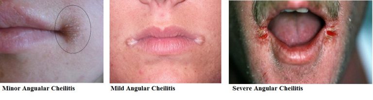 What Is Angular Cheilitis? Symptoms, Types, Causes, Chronic, Treatments ...