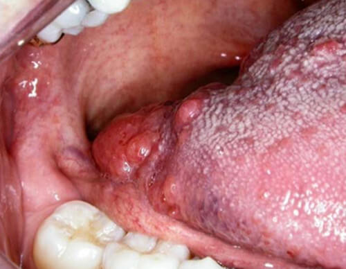 Painful and Enlarged Papillae on Tongue: Causes and Treatment
