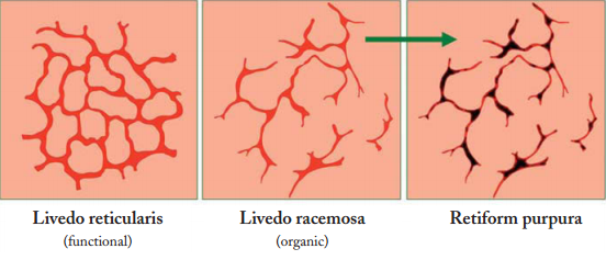 Livedo Reticularis Definition Causes Types Diagnosis Cure And Images Drugs Details 3201