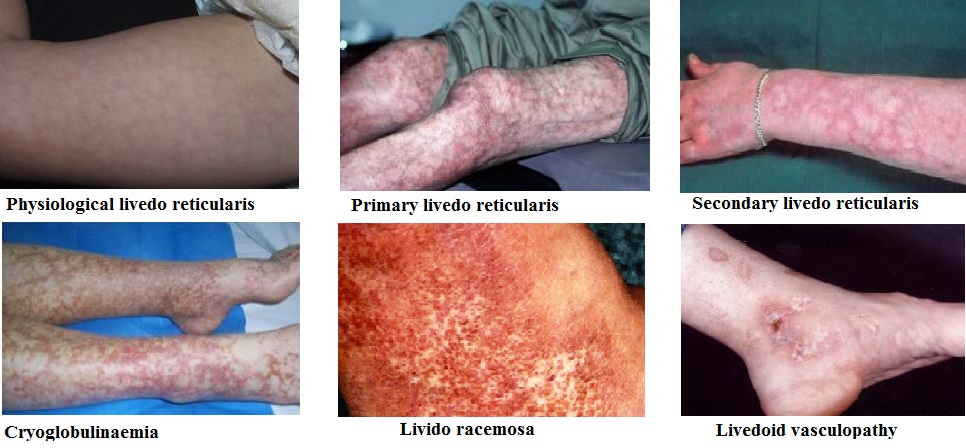 Livedo Reticularis - Definition, Causes, Types, Diagnosis, Cure
