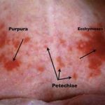 Ecchymosis - Definition, Types, Symptoms, Causes, Diet and Treatments, Pictures