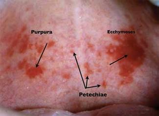 Ecchymosis - Definition, Types, Symptoms, Causes, Diet and Treatments, Pictures