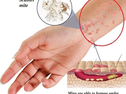 Scabies Skin Rash Pictures Causes Symptoms Home Remedy