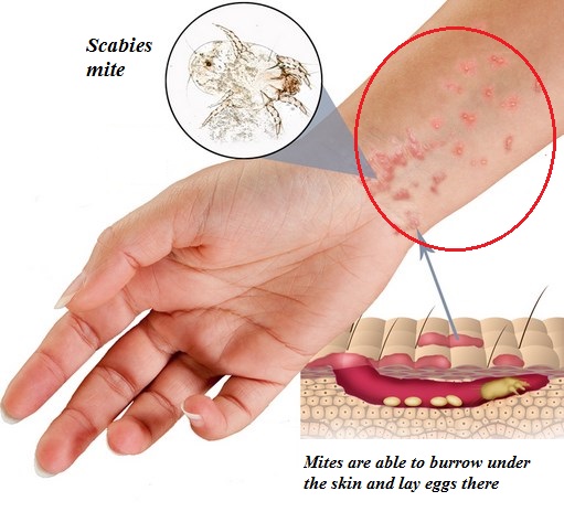 Scabies Rash Treatment, Symptoms and prevention