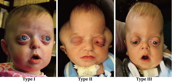 Pfeiffer Syndrome - Type 2 and 3, Symptoms, Causes, Treatments, Pictures