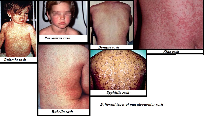 Maculopapular Rash Definition Signs And Symptoms Types Causes 