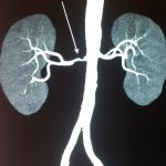 Azotemia - Definition, Development, Types, Diagnosis, Treatments