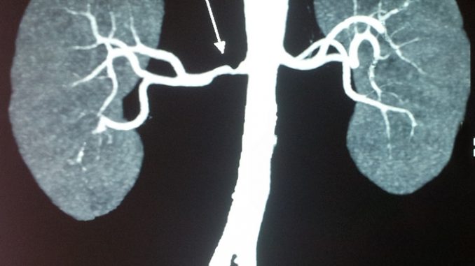 Renal stenosis Azotemia - Definition, Development, Types, Diagnosis, Treatments