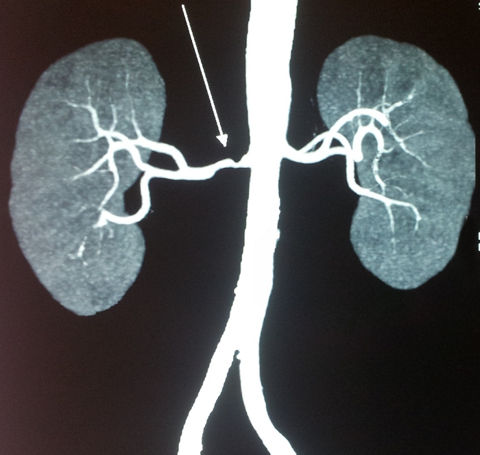 Azotemia - Definition, Development, Types, Diagnosis, Treatments