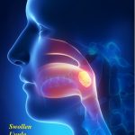 What causes the uvula to swell? How do you get rid of a swollen uvula?