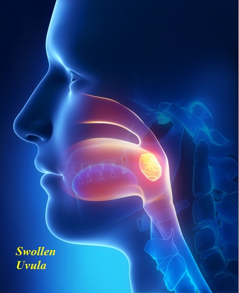 What causes the uvula to swell? How do you get rid of a swollen uvula?