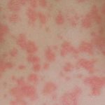 Maculopapular rash - Definition, Signs and Symptoms, Types, Causes, Treatments and Pictures
