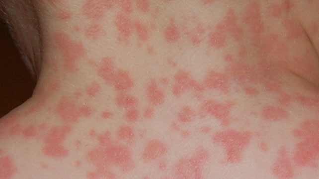 Maculopapular rash - Definition, Signs and Symptoms, Types, Causes, Treatments and Pictures