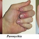 Herpetic whitlow - What is, Causes, Symptoms, Treatments and Pictures, Is it contagious?