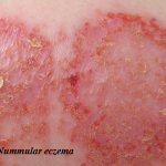 Nummular eczema - Definition, Complications, Causes, Treatments and Pictures - Baby