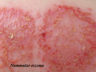 Nummular eczema - Definition, Complications, Causes, Treatments and Pictures - Baby
