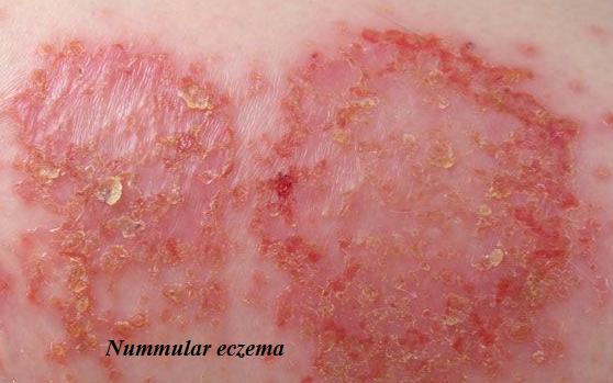 nummular-eczema-definition-complications-causes-treatments-and