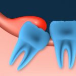 Pericoronitis - Definition, Reasons, Sign and Symptoms, Contagious, Pain management and Prevention