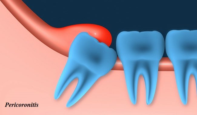 pericoronitis gum infection Pericoronitis - Definition, Reasons, Sign and Symptoms, Contagious, Pain management and Prevention