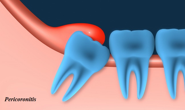 Pericoronitis - Definition, Reasons, Sign and Symptoms, Contagious, Pain management and Prevention