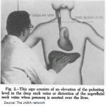 Jugular Venous Pulse (distention) - Definition, Causes, Location, Assessment
