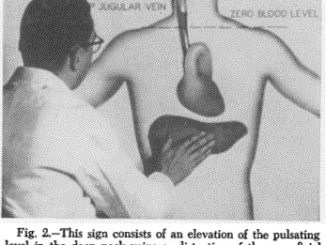 Jugular Venous Pulse (distention) - Definition, Causes, Location, Assessment