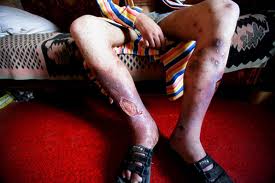 Krokodil drug : Ingredient, use, effects, abuse, addiction, high with pictures