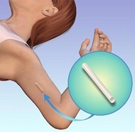 Nexplanon (Birth control implant): mechanism of action, effectiveness, side effects, insertion and removal